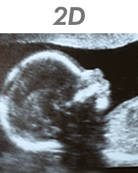 2d ultrasound